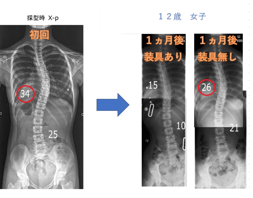 思春期特発性側弯症の治療例（シュロス法） | 西宮市苦楽園